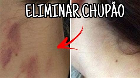 como tirar um chupao|Como tirar chupão: 8 truques simples para remover。